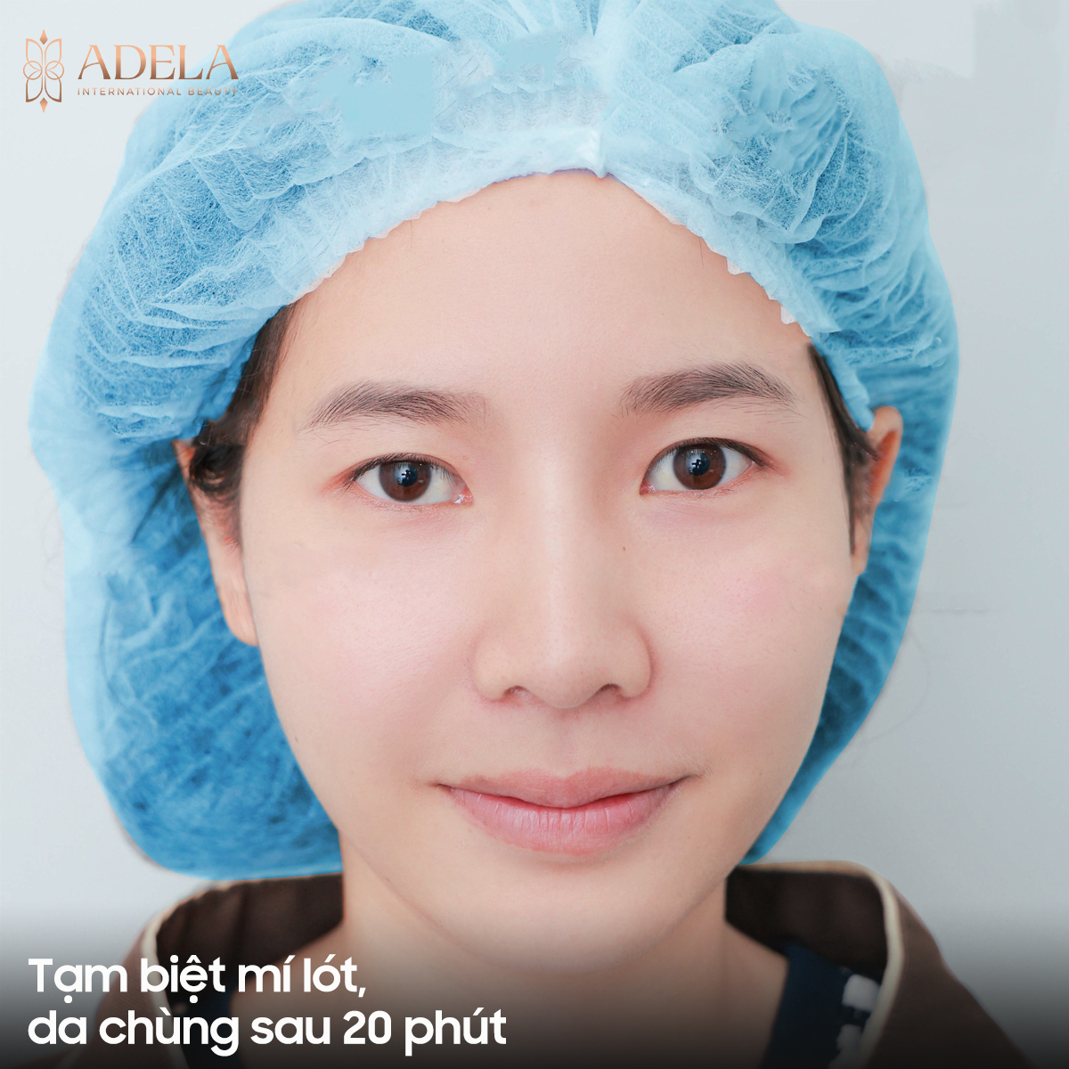 hình ảnh mắt 1 mí