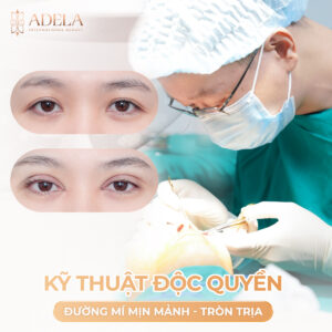 Bác sĩ phẫu thuật cắt mí mắt