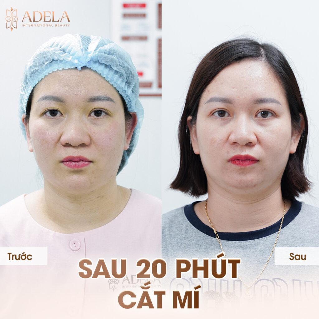 Hình ảnh người 1 mí, mắt ti hí