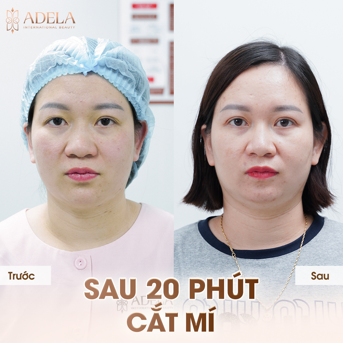 Hình ảnh người 1 mí, mắt ti hí