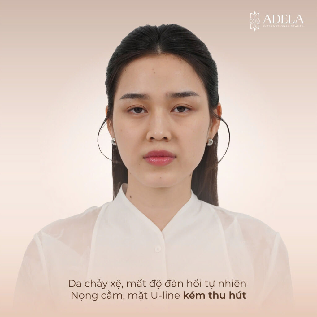  Khách hàng trước khi trải nghiệm Thermage 