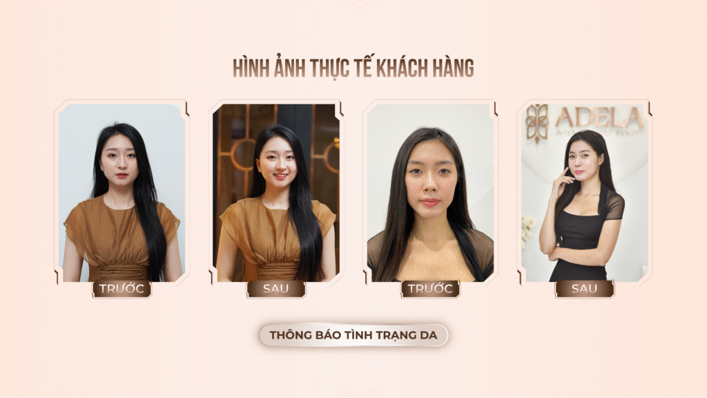 Viện thẩm mỹ Quốc Tế Adela 24 Bà triệu